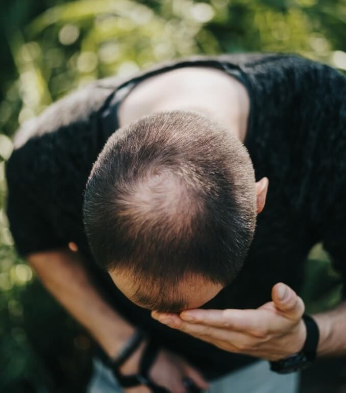 La calvitie : un sujet aussi émotionnel que physique