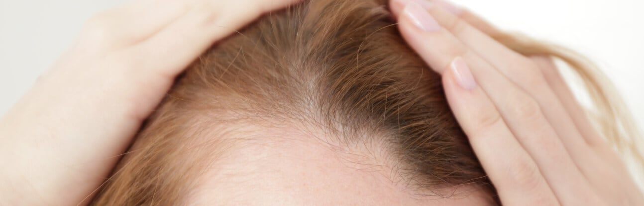 Alopécie : causes, prévention, traitements...et les hormones dans tout ça ?