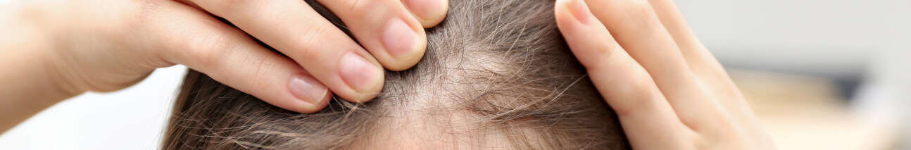 pourquoi risque-t-on de perdre ses cheveux ?