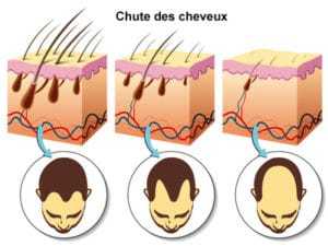 Infographie chute de cheveux