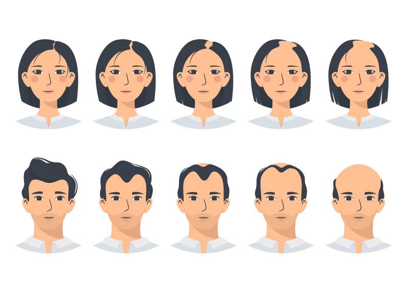 Calvitie chez la femme et l'homme. Les différents stades